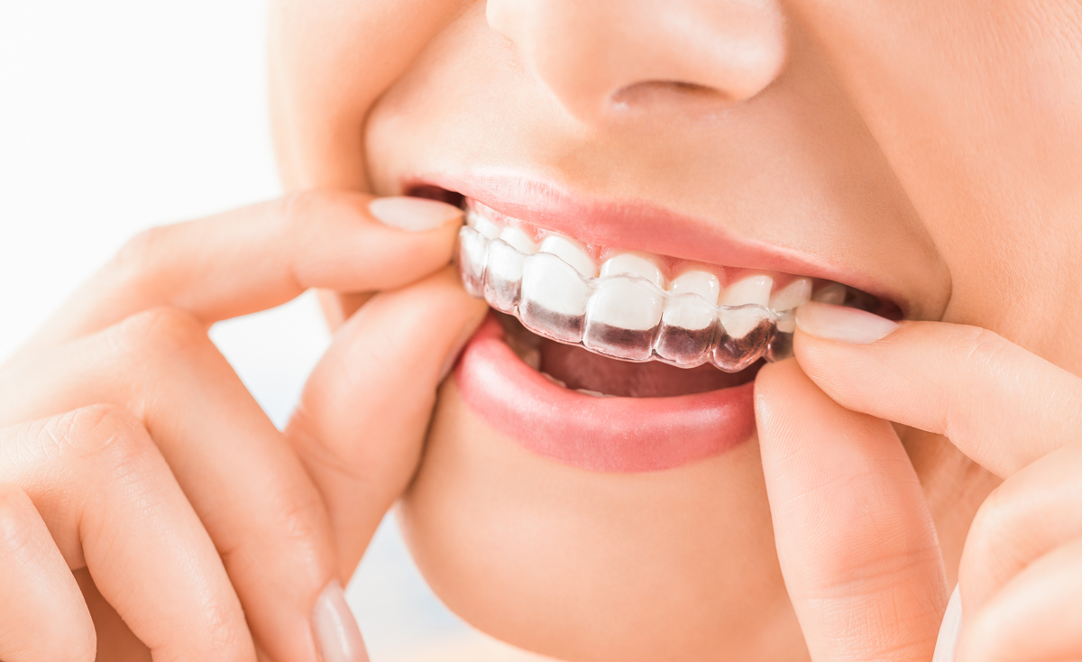 How Invisalign Can Correct Tooth Misalignment Without Traditional Braces