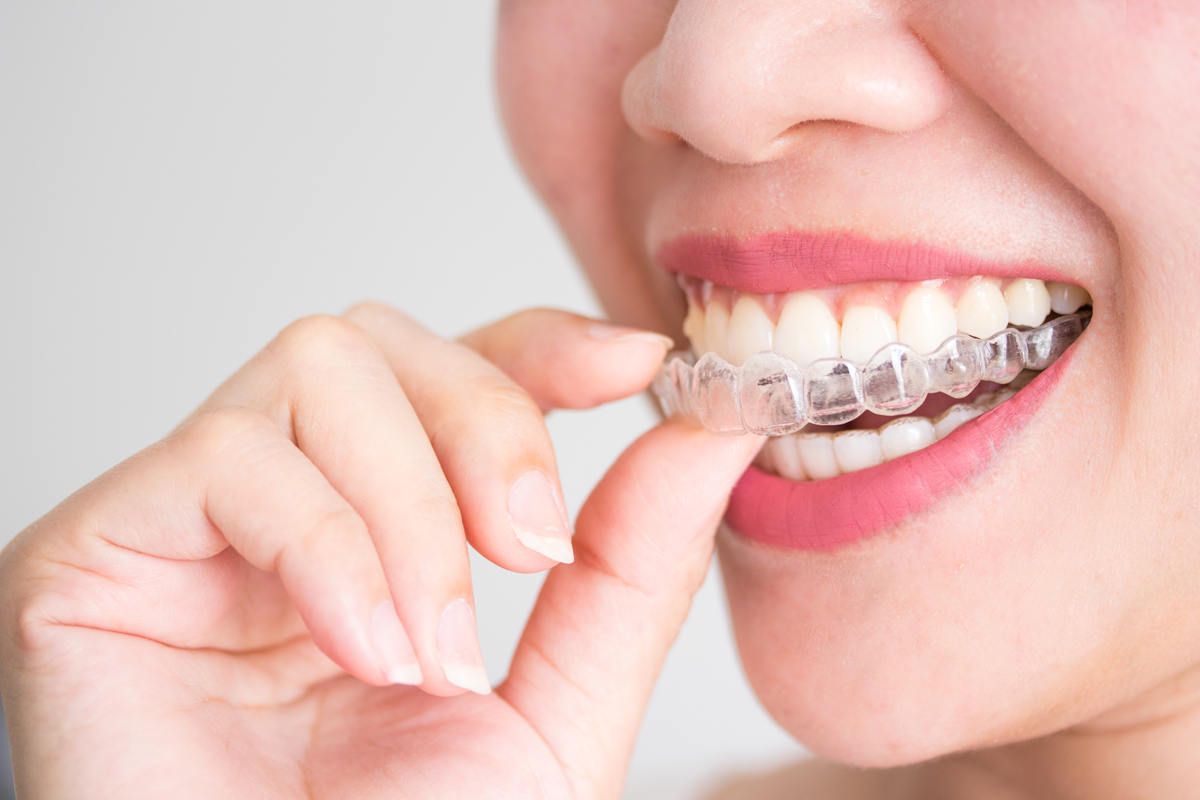 The Distinct Advantage of Invisalign Clear Aligners