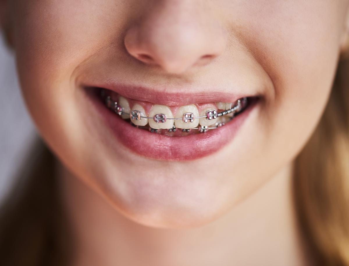 Life With Braces - What Is It Like?