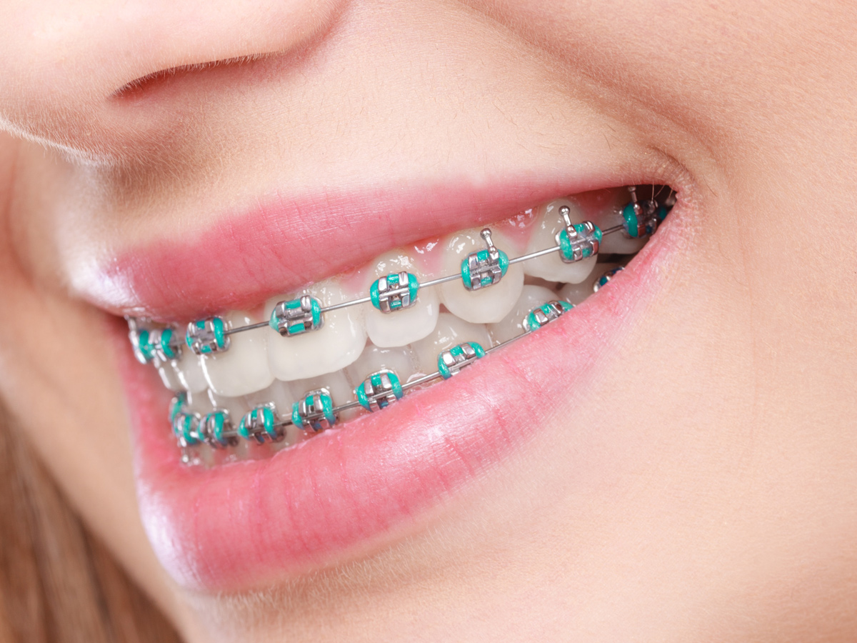 Choose Metal Braces For Extremely Overcrowded Teeth