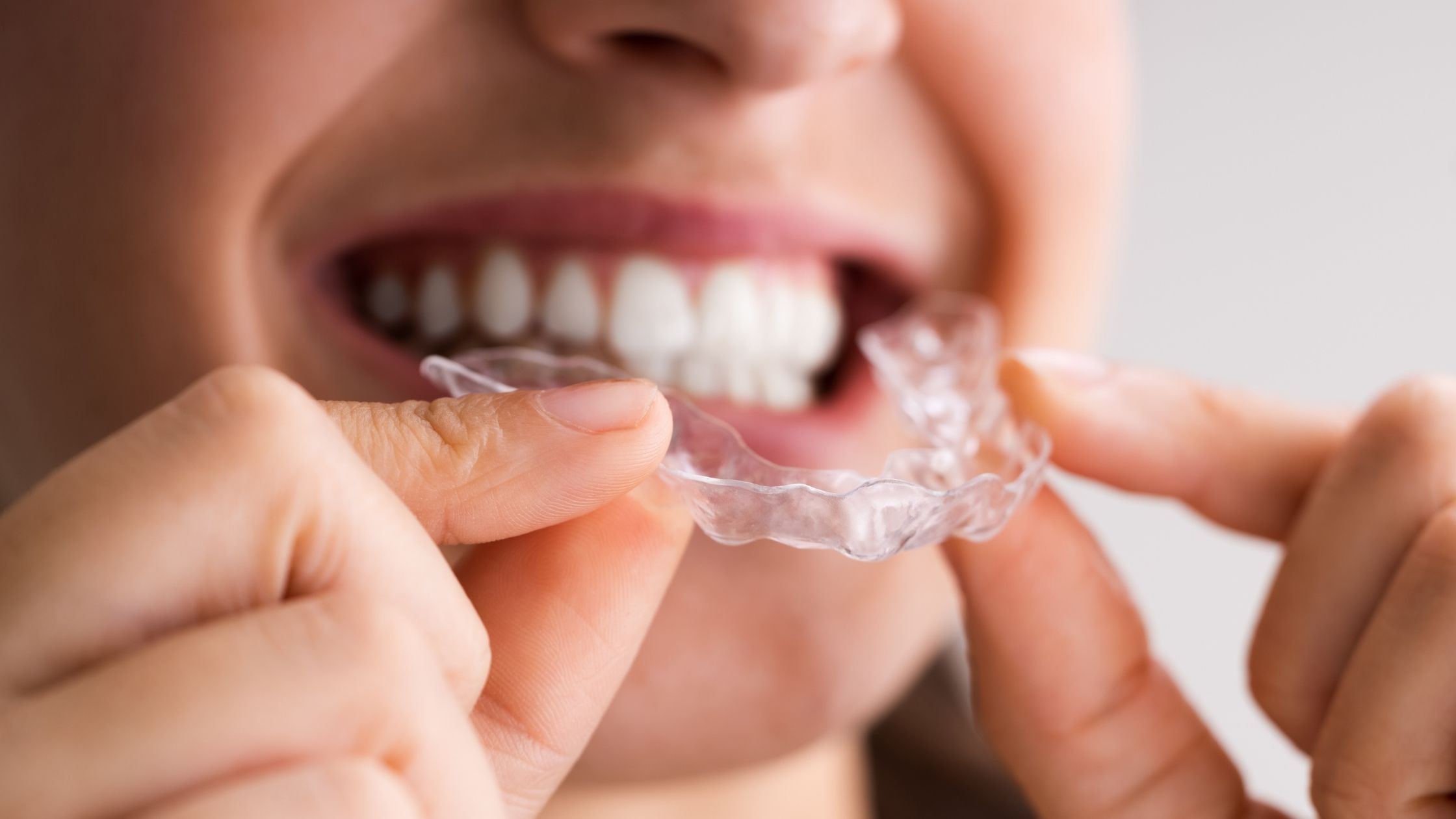 Spark Clear Aligners or Invisalign: Pros and Cons of Each